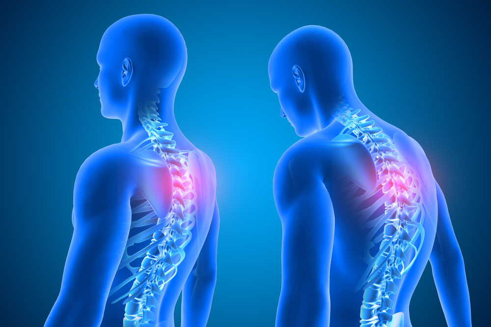 How To Fix Scoliosis With Chiropractic Care